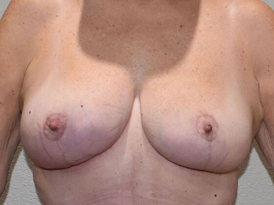 Breast Lift (Mastopexy) Case 284 - After
