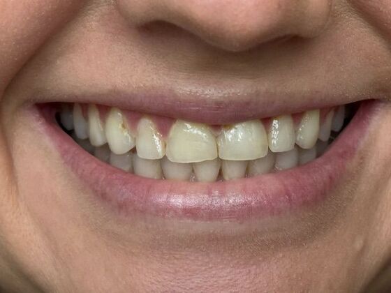 Porcelain Veneers: Case 1 - Before