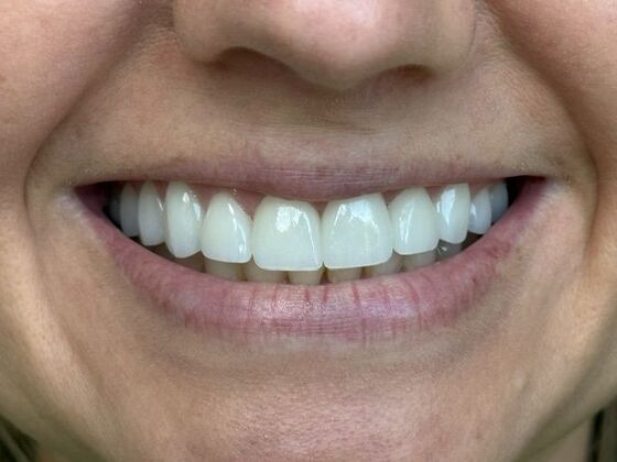 Porcelain Veneers: Case 1 - After