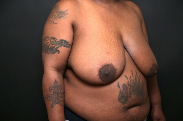 Breast Reduction Case 9 - Before