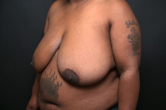 Breast Reduction: Case 9 - Before