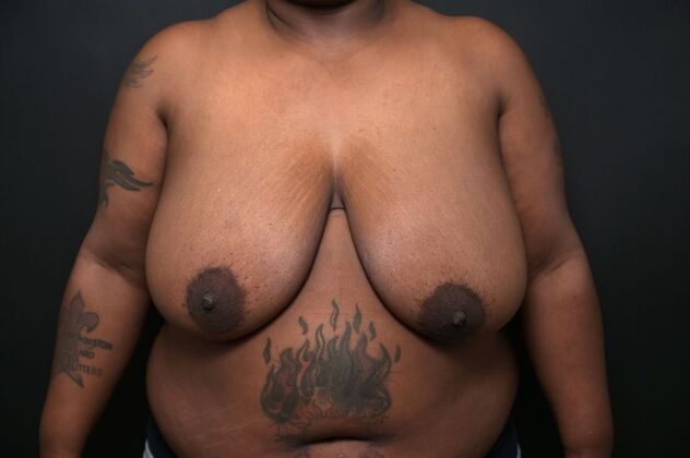 Breast Reduction: Case 9 - Before
