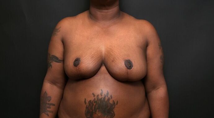 Breast Reduction: Case 9 - After
