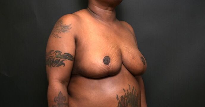 Breast Reduction Case 9 - After