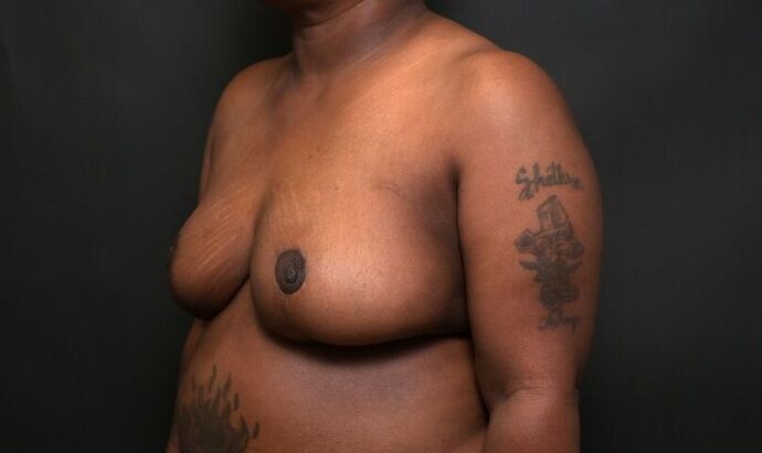 Breast Reduction: Case 9 - After
