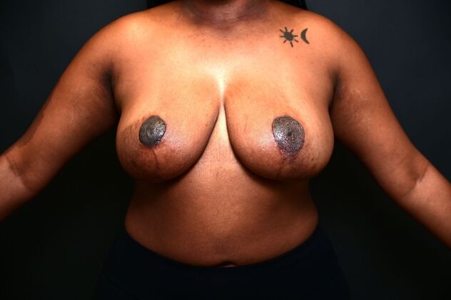 Breast Reduction: Case 10 - After