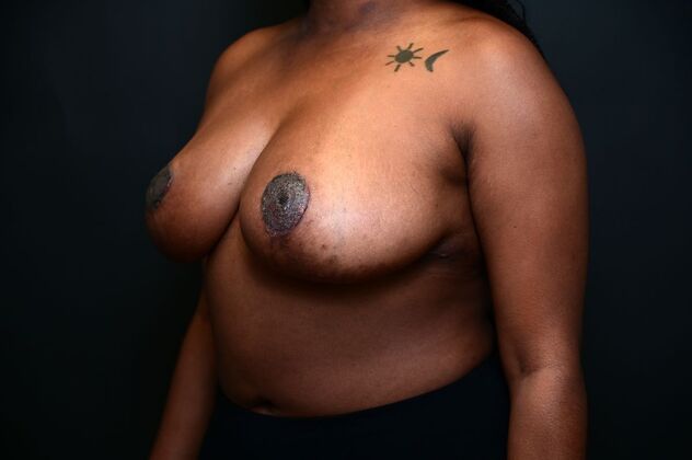 Breast Reduction Case 10 - After