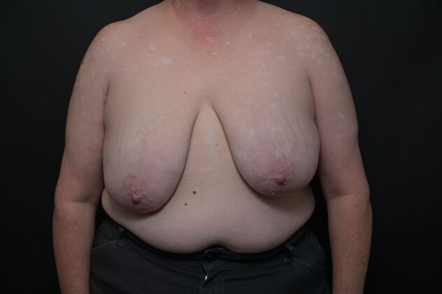Breast Reduction: Case 12 - Before
