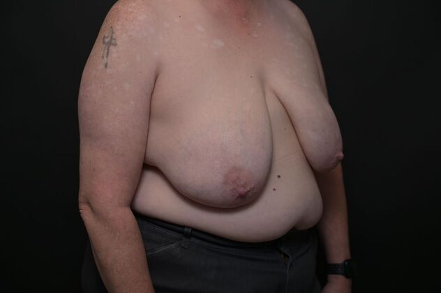 Breast Reduction Case 12 - Before