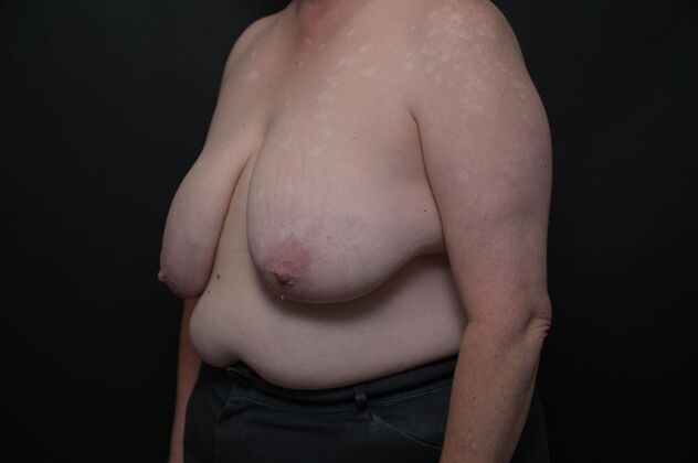 Breast Reduction: Case 12 - Before