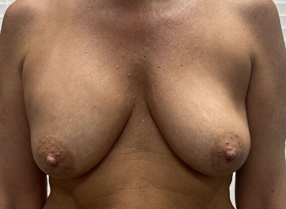 Breast Augmentation w/ Lift Case 20 - Before