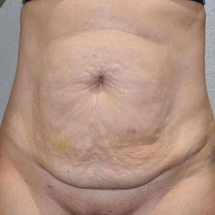 Tummy Tuck (Abdominoplasty): Case 612 - Before