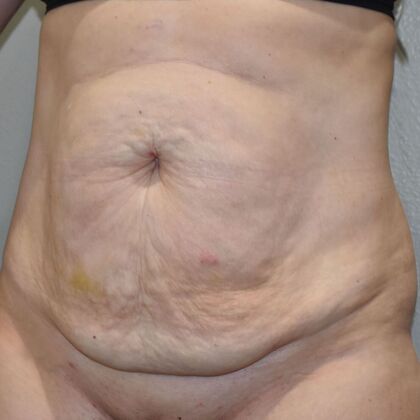 Tummy Tuck (Abdominoplasty): Case 612 - Before