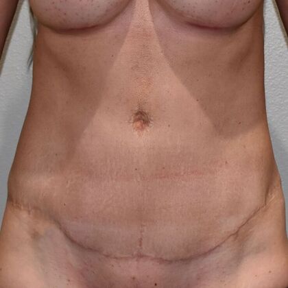 Tummy Tuck (Abdominoplasty): Case 612 - After