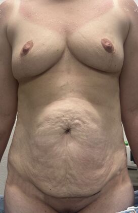 Mommy Makeover Case 22 - Before