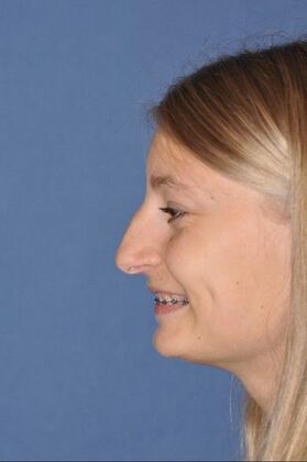 Rhinoplasty: Young lady with hanging tip and bump 2 years after surgery - Before