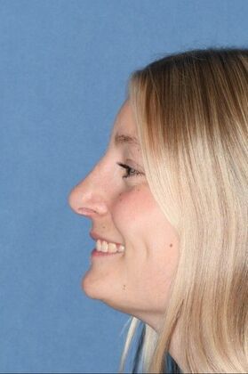 Rhinoplasty: Young lady with hanging tip and bump 2 years after surgery - After