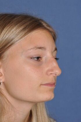 Rhinoplasty: Young lady with hanging tip and bump 2 years after surgery - Before