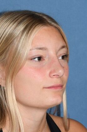 Rhinoplasty: Young lady with hanging tip and bump 2 years after surgery - After