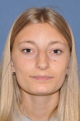 Rhinoplasty: Young lady with hanging tip and bump 2 years after surgery - Before