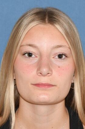 Rhinoplasty: Young lady with hanging tip and bump 2 years after surgery - After