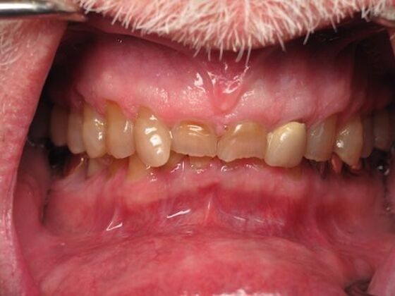 Full Mouth Rehabilitation with Crowns Case 3 - Before