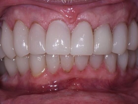 Full Mouth Rehabilitation with Crowns Case 3 - After