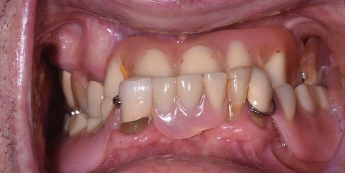 Full Mouth Rehabilitation with Dental Implants Case 6 - Before