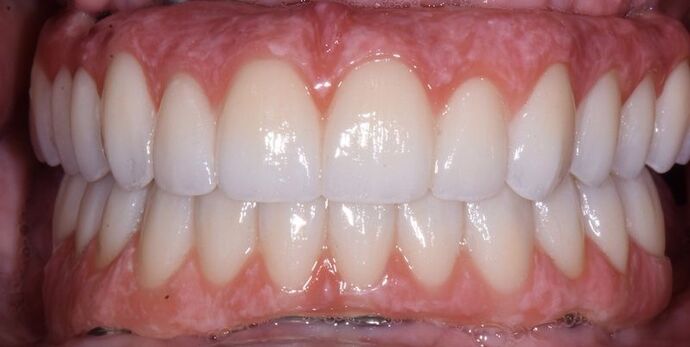 Full Mouth Rehabilitation with Dental Implants Case 6 - After