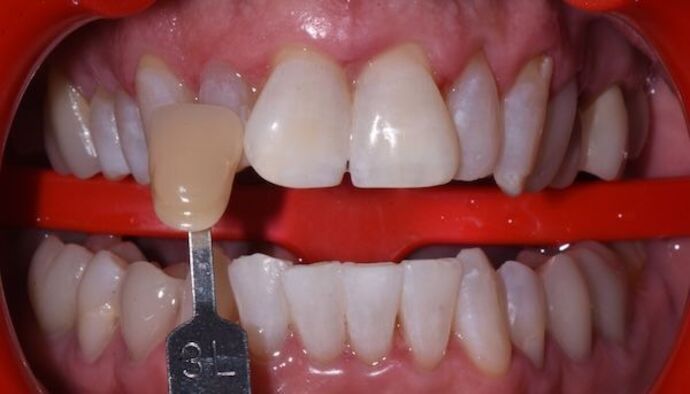 Whitening Case 2 - After