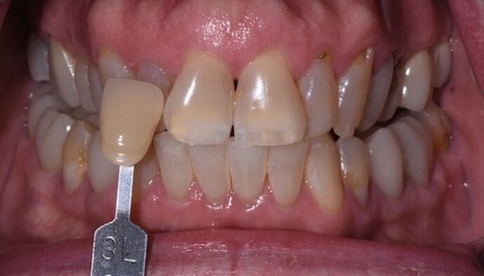 Whitening Case 2 - Before