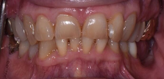 Whitening Case 3 - Before