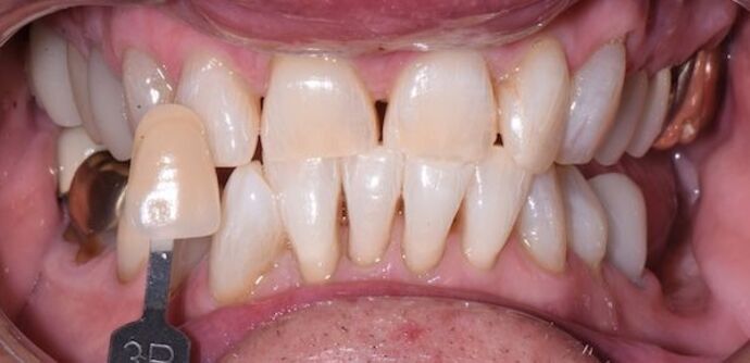 Whitening Case 3 - After