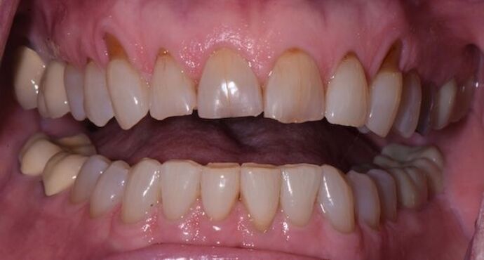 Whitening Case 4 - Before