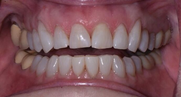 Whitening Case 4 - After