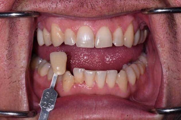 Whitening Case 5 - Before