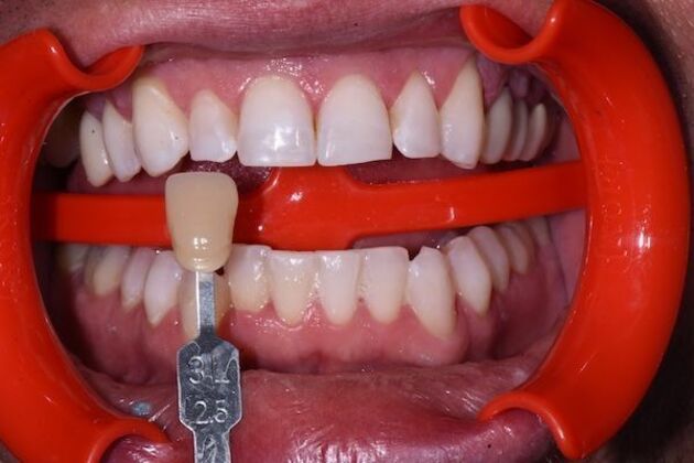 Whitening Case 5 - After