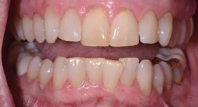 Whitening Case 6 - Before