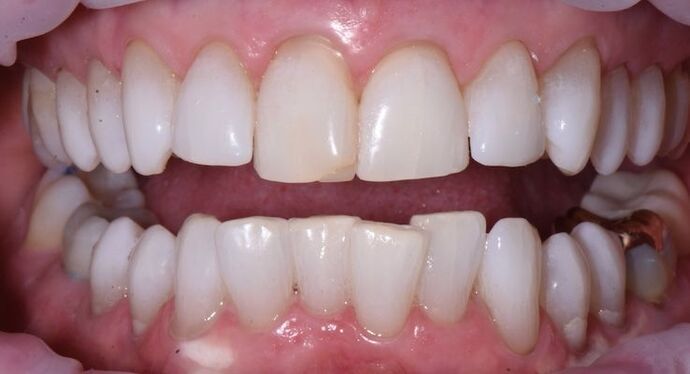 Whitening Case 6 - After