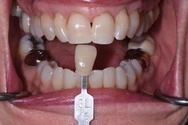 Whitening Case 7 - Before
