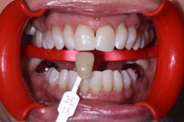 Whitening Case 7 - After