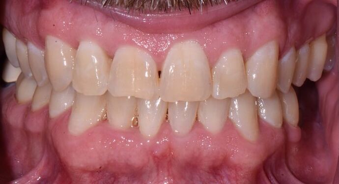Whitening Case 8 - Before