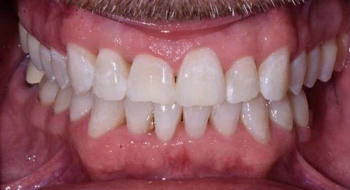 Whitening Case 8 - After