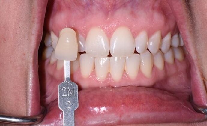 Whitening Case 9 - Before