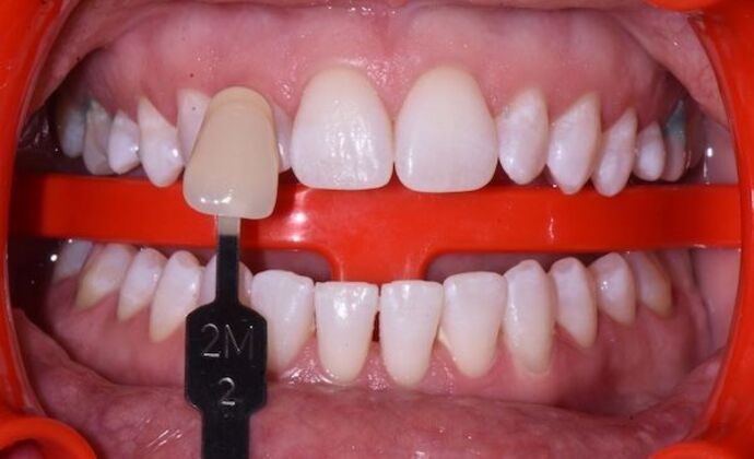 Whitening Case 9 - After