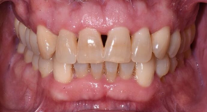 Whitening Case 10 - Before