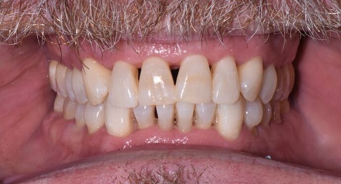 Whitening Case 10 - After