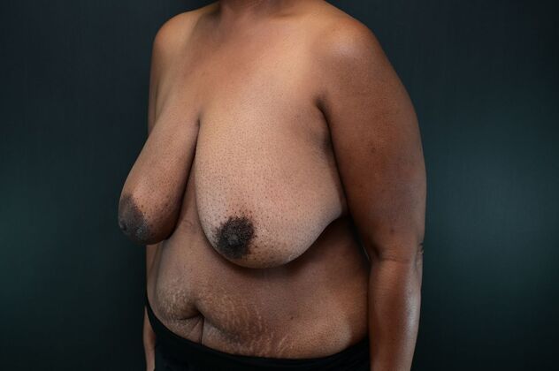 Oncoplastic Breast Reduction: Case 1 - Before