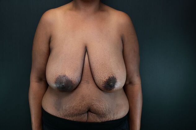 Oncoplastic Breast Reduction: Case 1 - Before