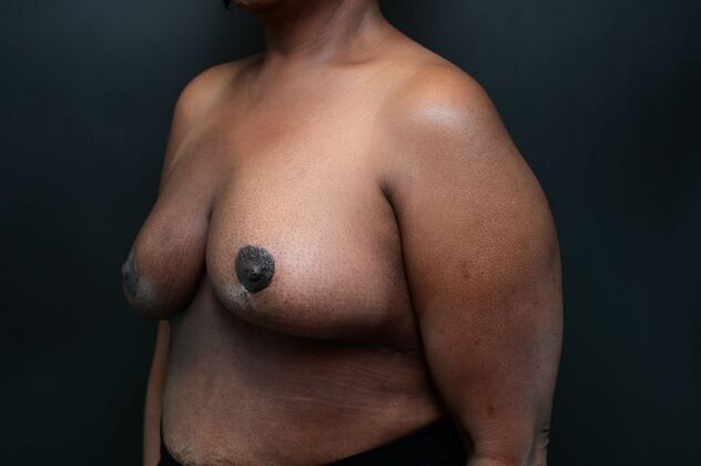 Oncoplastic Breast Reduction: Case 1 - After